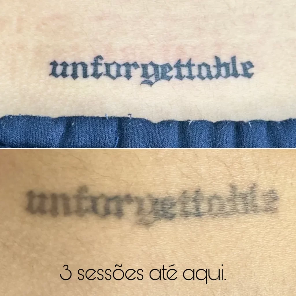 remoção de tatuagem por tanara miranda - magnifc beauty