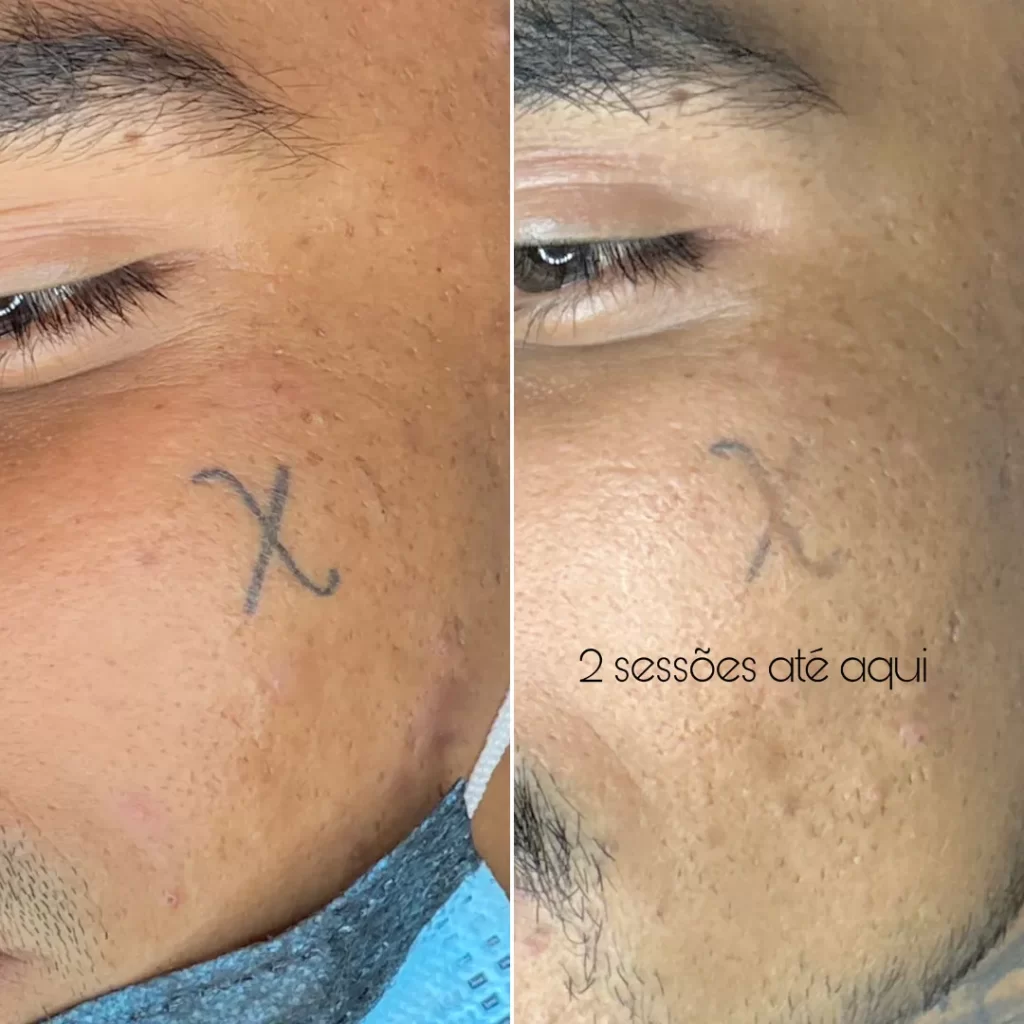 remoção de tatuagem por tanara miranda - magnifc beauty