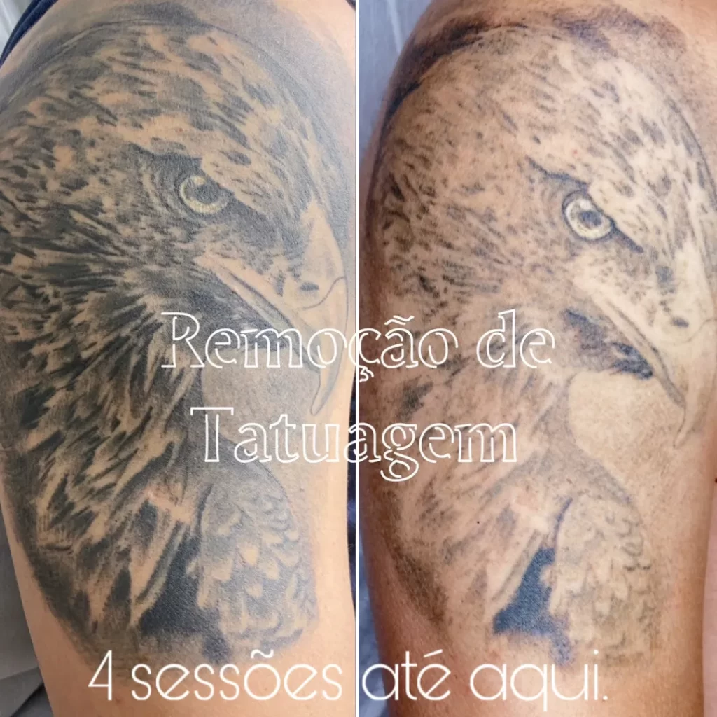 remoção de tatuagem por tanara miranda - magnifc beauty