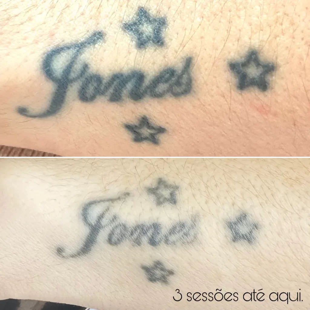 remoção de tatuagem por tanara miranda - magnifc beauty